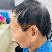 Máy trợ thính siêu nhỏ trong tai CIC